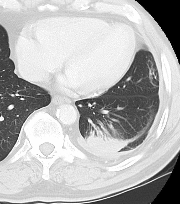 Rounded atelectasis case 1 CT