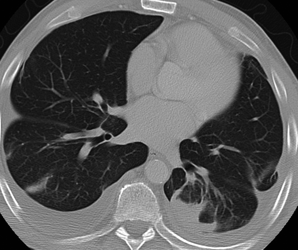 Rounded atelectasis case 2