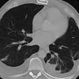 Rounded atelectasis case 2