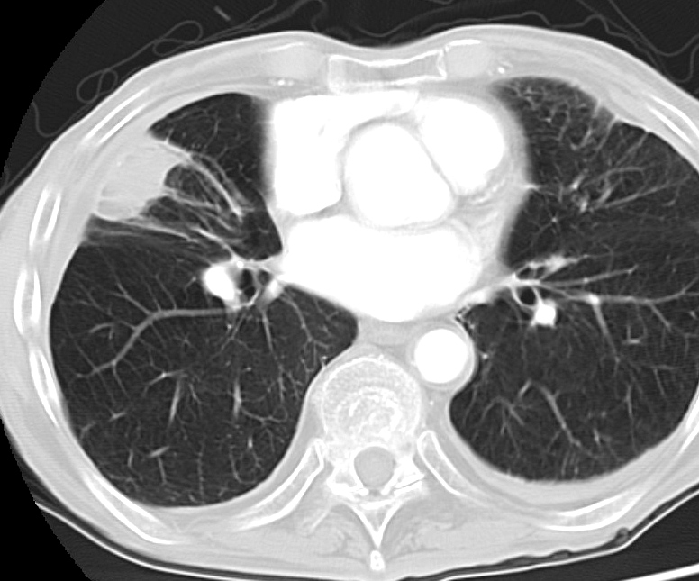 Rounded atelectasis case 3