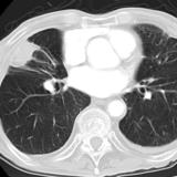 Rounded atelectasis case 3