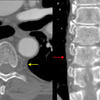 Paraspinal lines