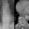 Paraspinal lines