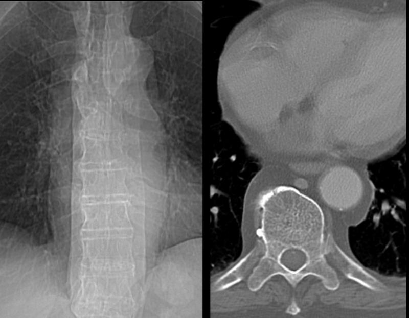 Paraspinal lines