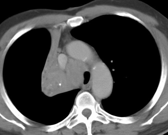 RUL Collapse Case 1 CT(a)