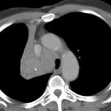 RUL Collapse Case 1 CT(a)