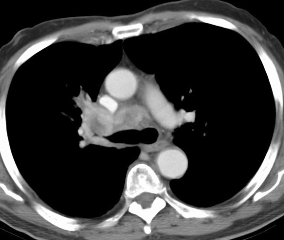 RUL Collapse Case 1 CT(b)