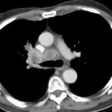 RUL Collapse Case 1 CT(b)