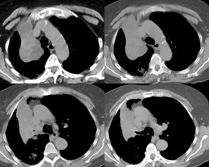 RUL Collapse Case 2 CT  4in1