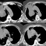 RUL Collapse Case 2 CT  4in1