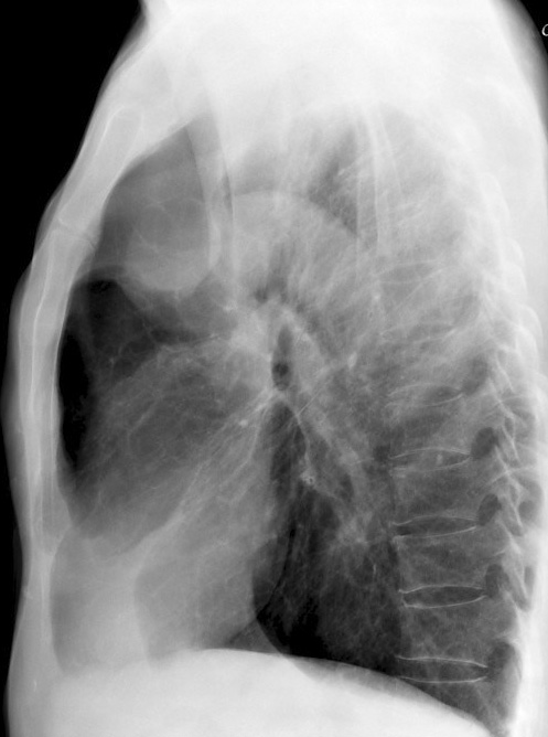 RUL Collapse Case 3 Lateral