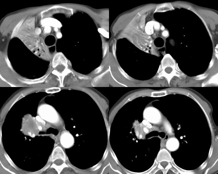 RUL Collapse Case 3 CT 4in1