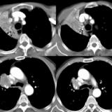 RUL Collapse Case 3 CT 4in1