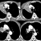 RUL Collapse Case 3 CT 4in1