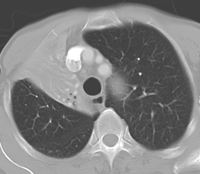 RUL Collapse Case 3 CT