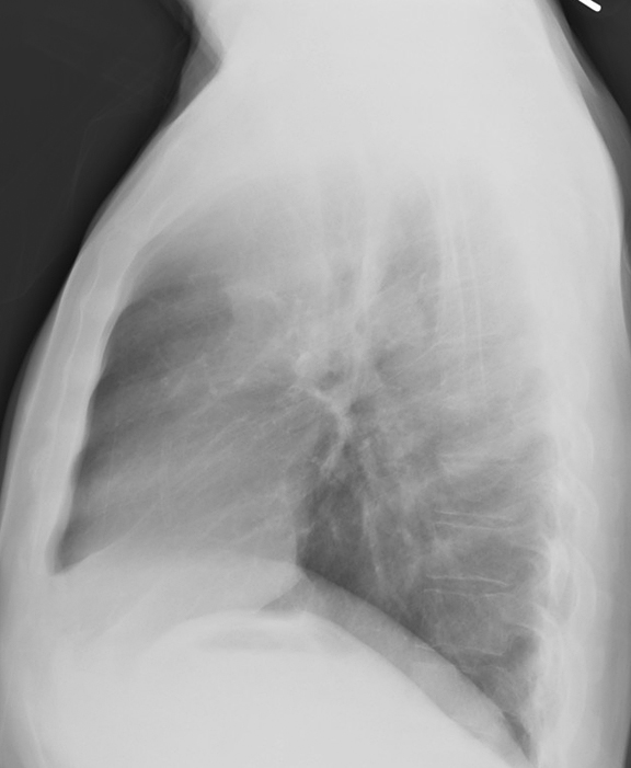 RUL Collapse Case 4 Lateral