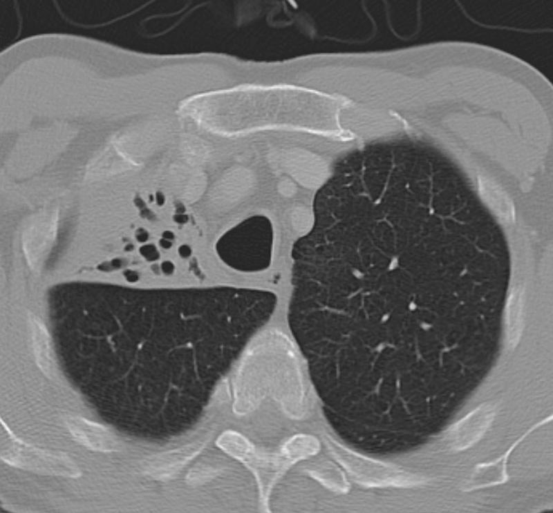 RUL Collapse Case 9 CT