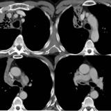 RUL Collapse Case 9 CT