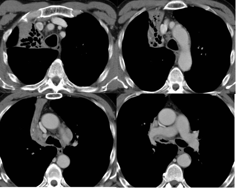 RUL Collapse Case 9 CT