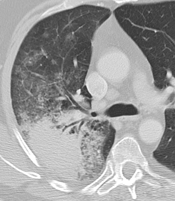 BAC Case 1 CTcu