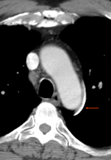 Ao nipple 
(left superior intercostal vein)