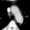 Ao nipple 
(left superior intercostal vein)