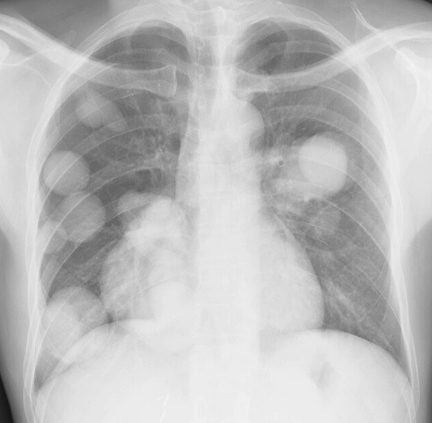 adrenal PA