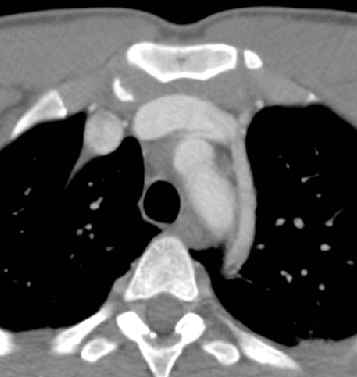 Lt sup intercostal vein
(different patient)