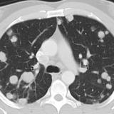 Testicular mets CT