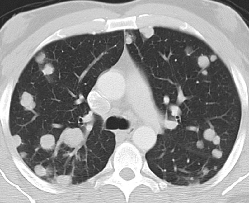 Testicular mets CT