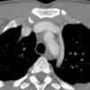 Lt sup intercostal vein
(different patient)