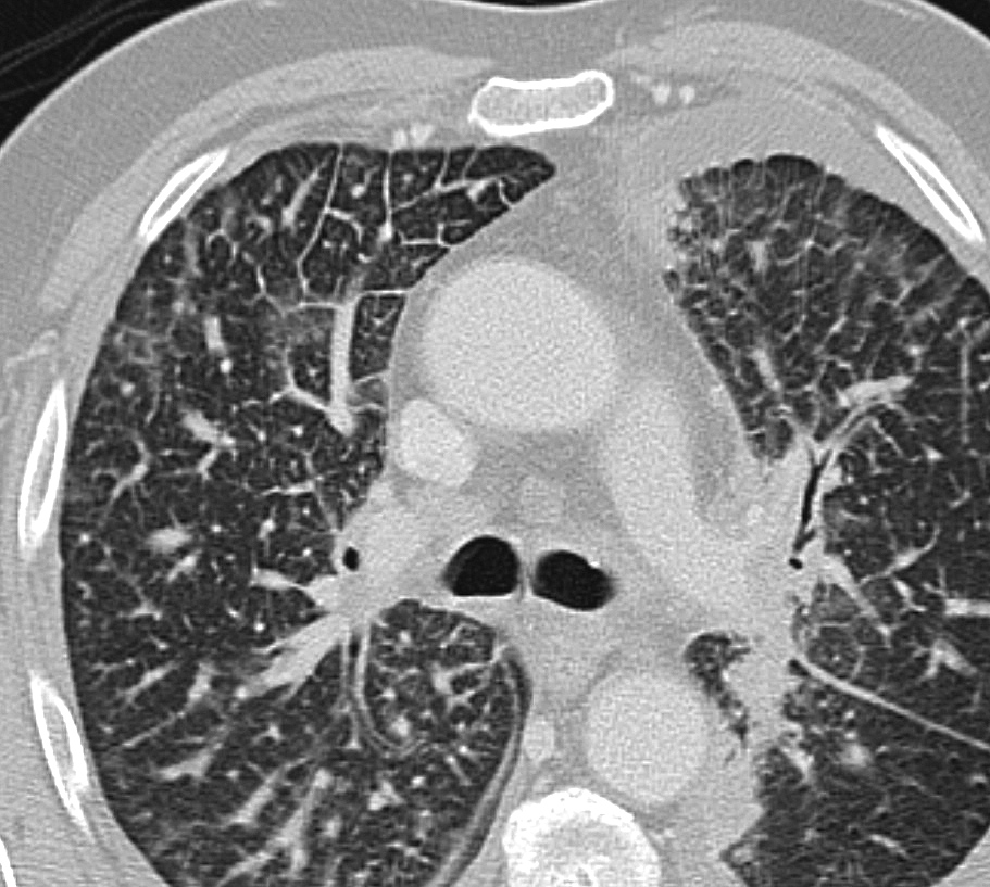 lymphangitic Case 3a