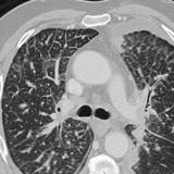 lymphangitic Case 3a