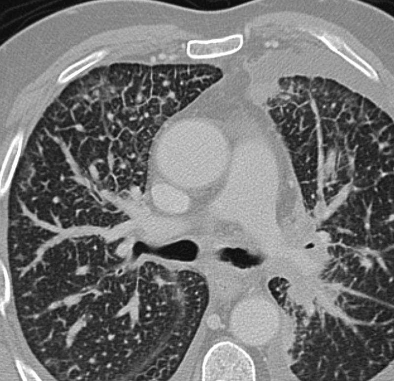 lymphangitic Case 3b