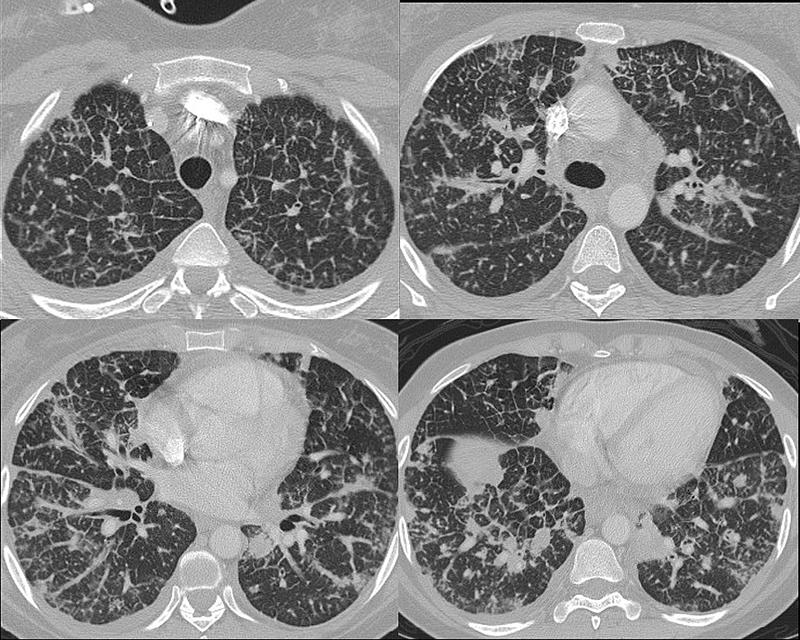 Lymphangitic 4 CT 