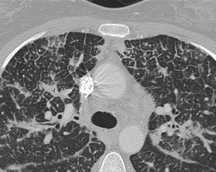 Lymphangitic CT 4 closeup