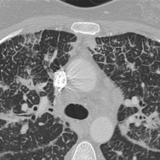 Lymphangitic CT 4 closeup