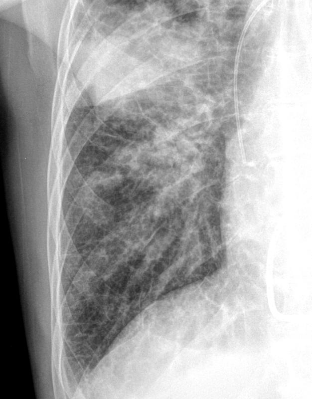 Lymphangitic 5 Xray