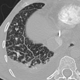 Lymphangitic 5 CT