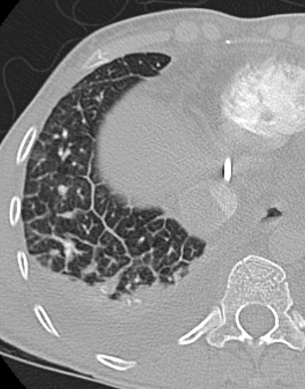 Lymphangitic 5 CT