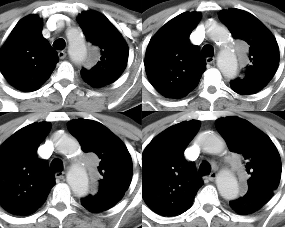 melanoma 3c