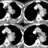 melanoma 3c