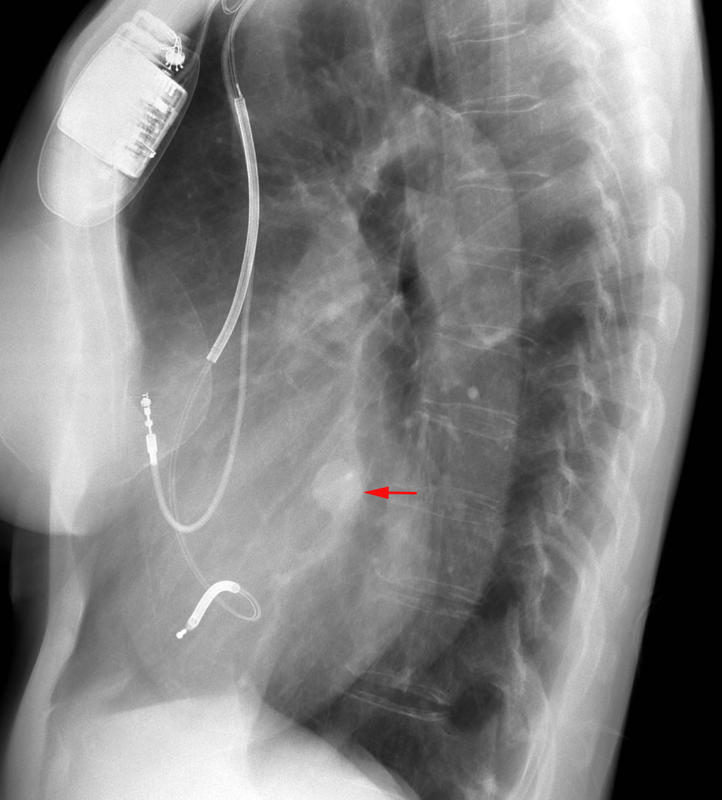 Pul vein lateral
Not usually this well defined...needs to be perfectly horizontal