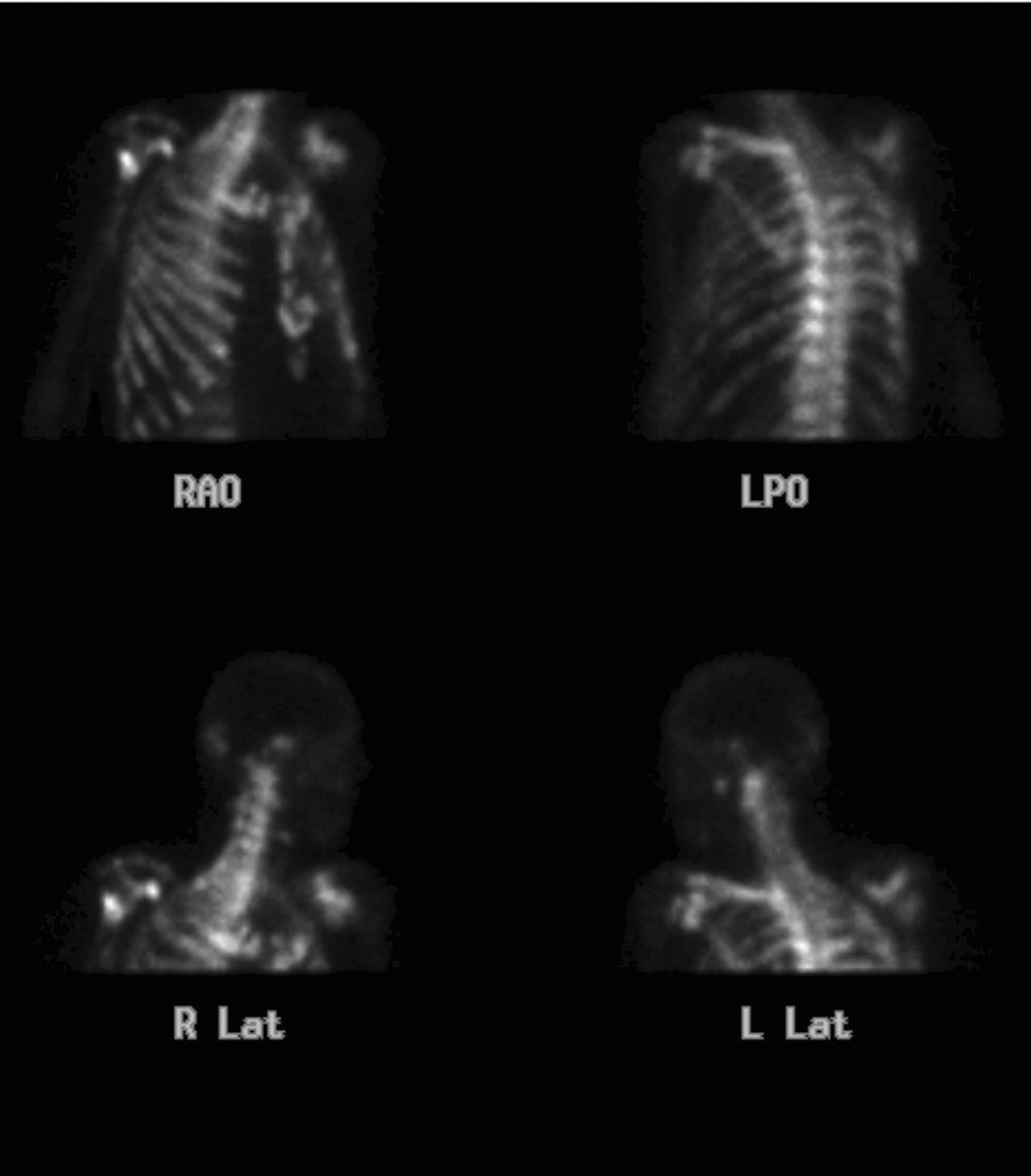 Prostate Bone scan