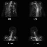 Prostate Bone scan