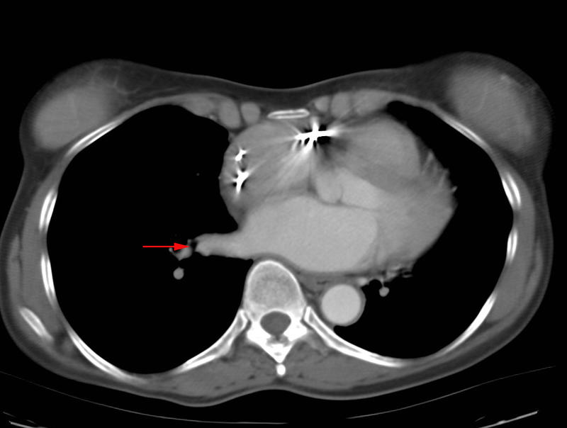 Pul vein CT