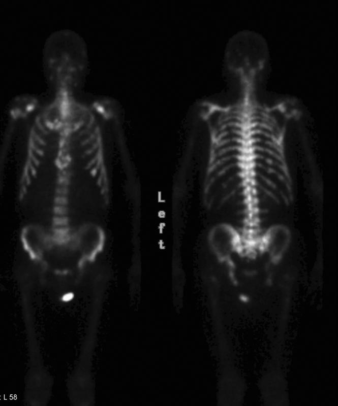 Prostate Bøne scan