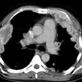 Renal cell to pleura