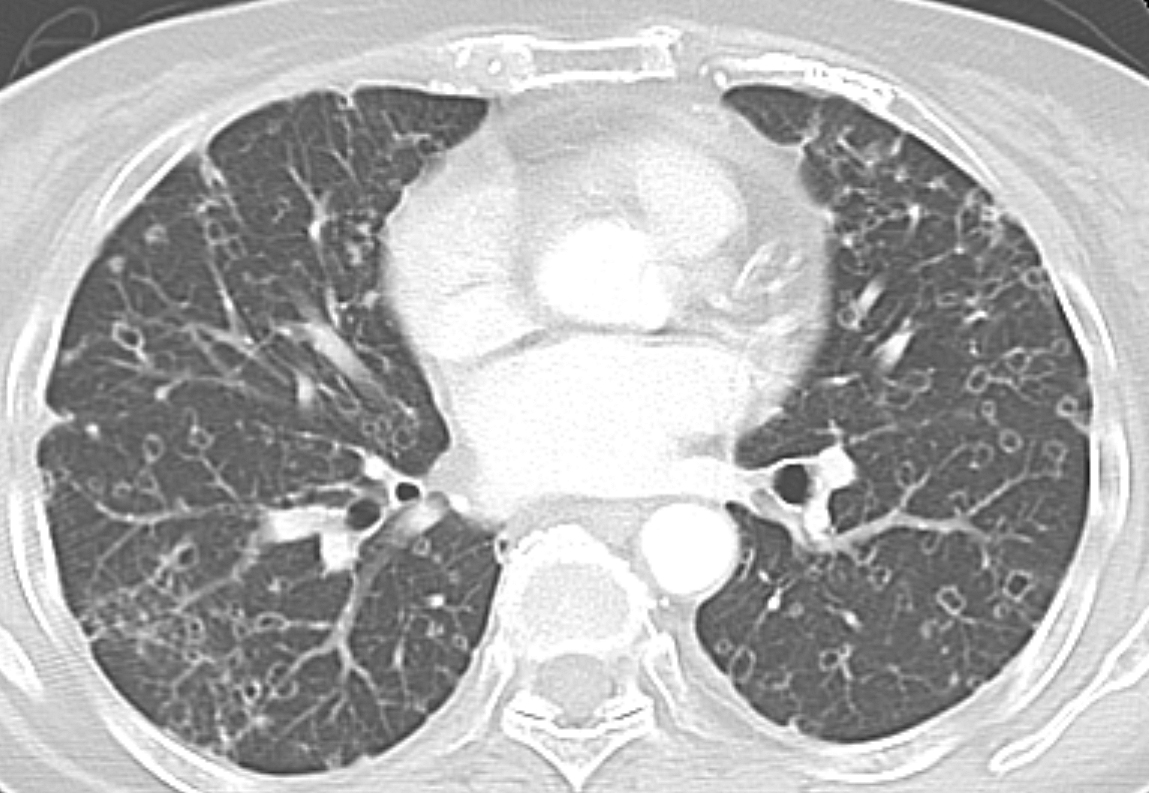 cystic mets (pancreas adenoca)