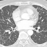 cystic mets (pancreas adenoca)